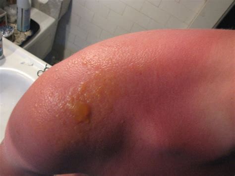 sunburn blisters of a person exposed to a significant amount of sun for three days without ...