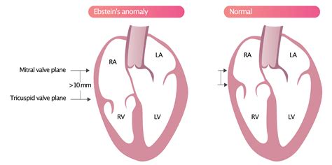 Tricuspid Valve