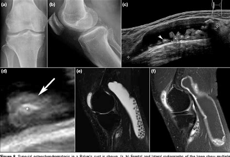 Popliteal Cyst