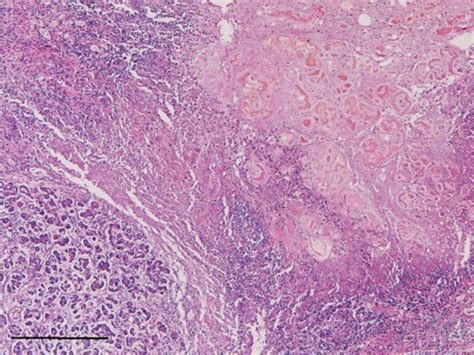 Acute Pancreatitis Histology