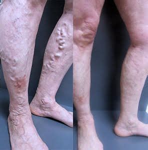 Venous eczema treatment | Melbourne varicose vein clinic