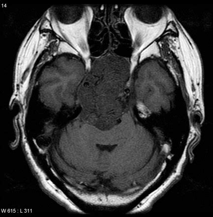 Clival masses | Radiology Reference Article | Radiopaedia.org