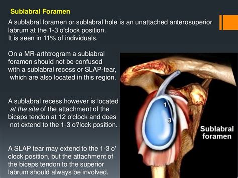 Shoulder labral tears MRI