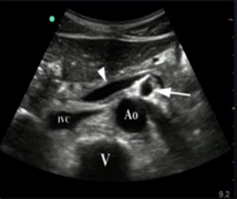 Abdominal Aorta Ultrasound