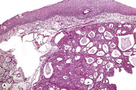 Tumors of the conjunctiva | Basicmedical Key