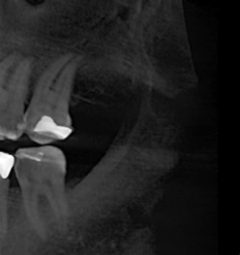 Dental Cavitation ☎️ We find new solutions for a perfect smile