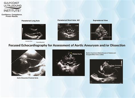 Thoracic Aortic Aneurysm Echocardiogram