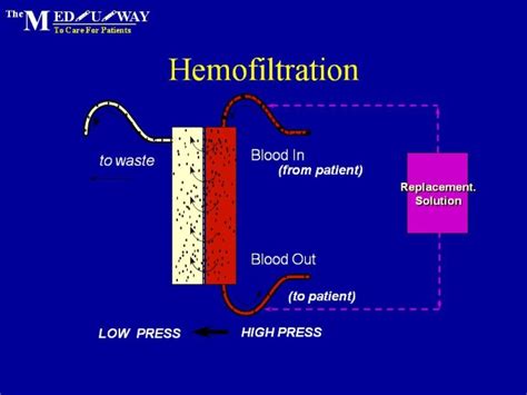 Hemofiltration; Arteriovenous Hemofiltration; CAVH; Hemofiltration ...