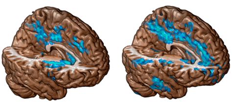 Cocaine May Age the Brain | Science | AAAS