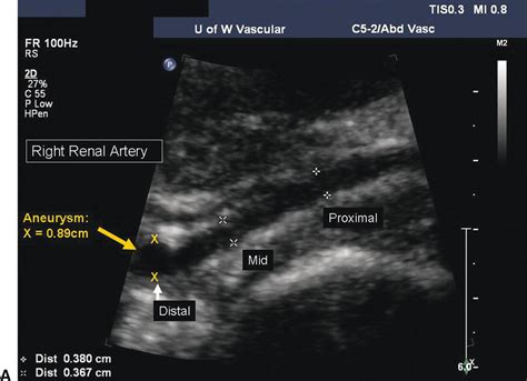 Renal Duplex Scanning | Thoracic Key