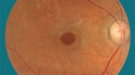 Macular Hole: Diagnosing and Treating This Tricky Eye Problem