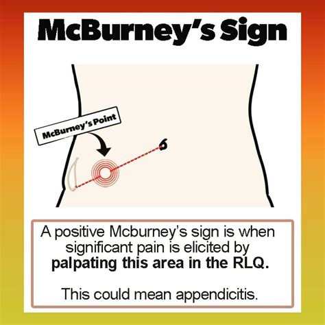 بيت التمريض - McBurney's point refers to the point 3.8–5.1...