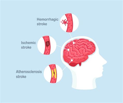 Tipi di ictus cerebrale umano. malattia ischemica, aterosclerosi e ...