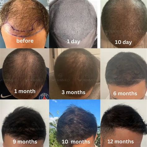 Hair Transplant Timeline Progress l 0 to 12 Months Photos