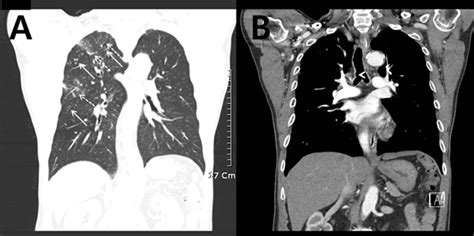 Chest computed tomography shows clustered centrilobular nodules (arrows... | Download Scientific ...