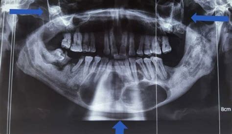 OPG showing multiple radiolucency with corticated margin in anterior... | Download Scientific ...