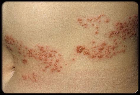 Hot Tub Rash | Japan | PDF | PPT| Case Reports | Symptoms | Treatment