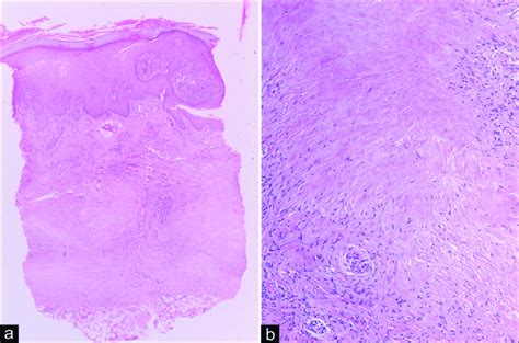 Necrobiosis lipoidica: (a) showing necrobiosis mainly involving middle ...