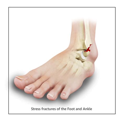 Stress Fractures Los Angeles | Hairline Fracture | Fissure Fracture La Canada