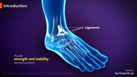 Ankle Syndesmosis Surgery Video | Syndesmosis With Tightrope