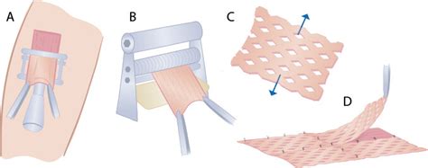 Split Thickness Skin Graft