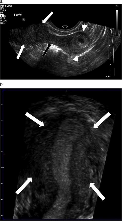 Sonographic findings of early pregnancy in the rudimentary horn of a unicornuate uterus: A two ...