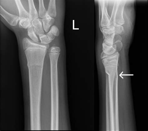 Greenstick Fracture X Ray