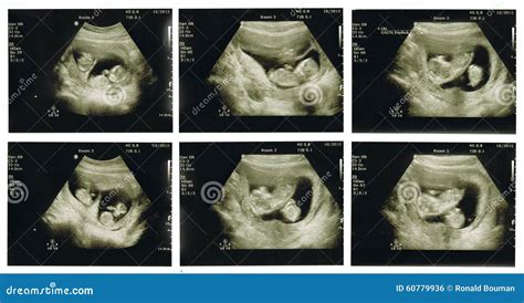 Six Ultrasound Scans of Baby Twins at 12 Weeks Stock Photo - Image of ...