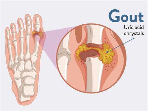 Why Are Some At Risk For Gout Disease? | Health And Medicine