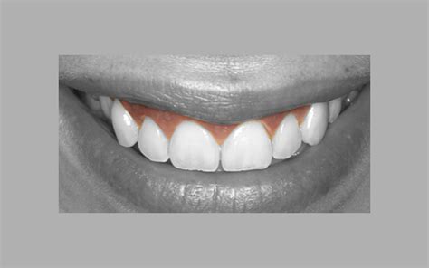 Sonrisa Gingival | Argensola Formación