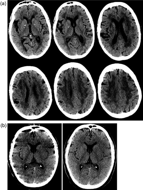 Leukoaraiosis (white matter disease), brain atrophy, and motion... | Download Scientific Diagram