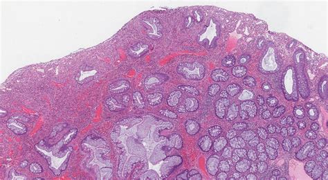 A Mucosa De Colon Transverso Con Infiltrado Inflamatorio De Tipo ...