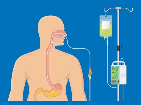 Different Types Of Enteral Feeding Tubes at Roberta Gabriel blog