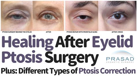 Healing After Ptosis Surgery | Dr. Prasad Blog