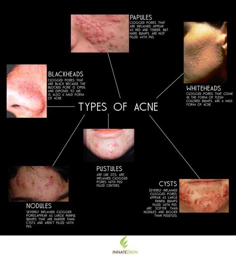 How to Recognize What Kind of Acne You Have | Innate Skin | Types of ...