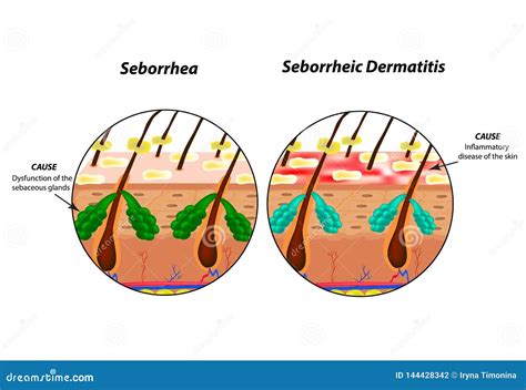 Causes Seborrhea Skin and Hair. Dandruff Seborrheic Dermatitis. Eczema ...