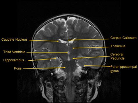 Parahippocampal Gyrus Mri