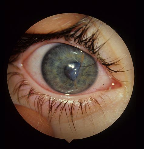 Ocular Laceration - The Clinical Advisor