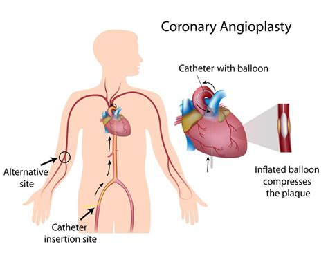 Coronary Intervention - Angioplasty and Stent Placement ...