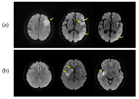 Diagnostics | Free Full-Text | Automatic Assessment of ASPECTS Using Diffusion-Weighted Imaging ...