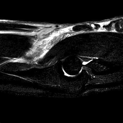 Distal Biceps Tendon Rupture | The Bone School