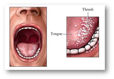 Oral Thrush Under Tongue