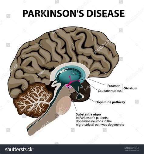 Parkinsons Disease Crosssection Human Brain Showing Stock Vector ...