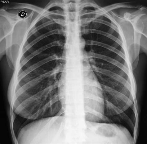 Rx de Tórax Normal | Anatomia del hueso, Imagenologia, Imagenes de medicos