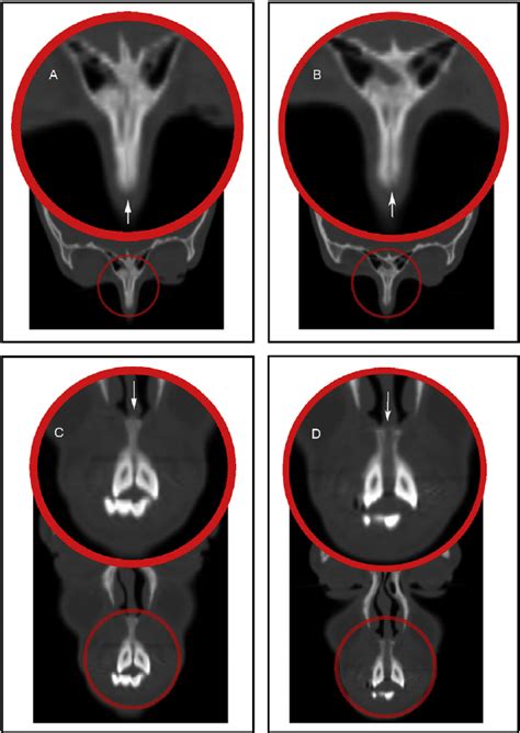 Coronal CT section rotated in a 45 clockwise direction showing: A, the... | Download Scientific ...