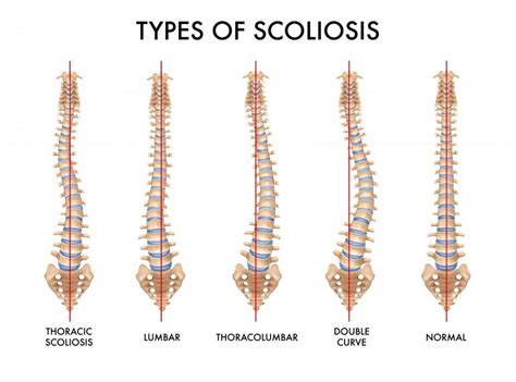 Scoliosis - Symptoms, Types and Causes - Island Orthopaedics