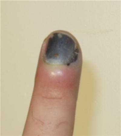 Nail Bed Injury - Hand - Orthobullets