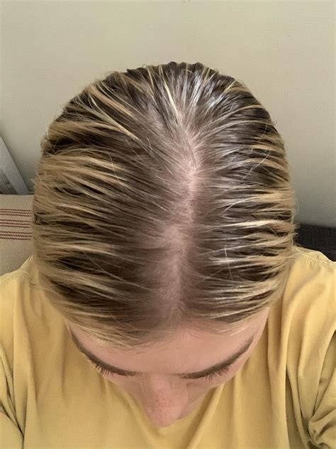 Should I be concerned about this hair loss/thinning? : r/FemaleHairLoss