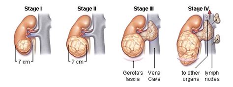 kidney cancer treatment centers in india| kidney cancer surgery in Chennai