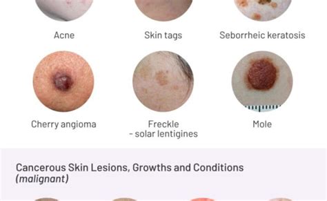 Skin Lesions Types Pictures Prevention – Otosection